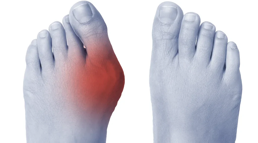 bunions - foot with bunions that are red with pain